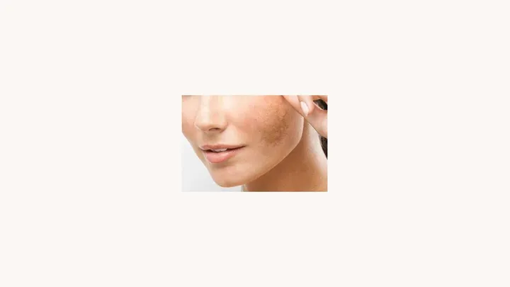 13 Alimentos Que Pioram o Melasma