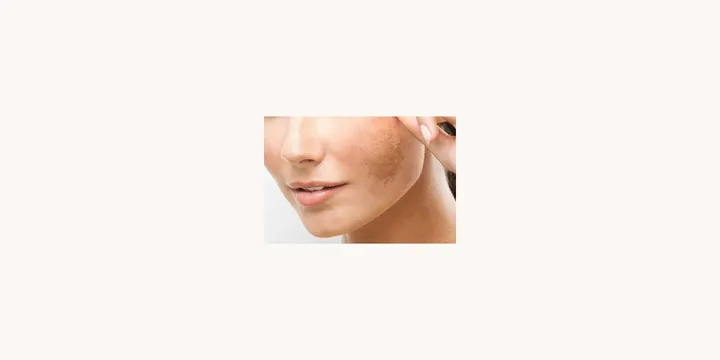 13 Alimentos Que Pioram o Melasma
