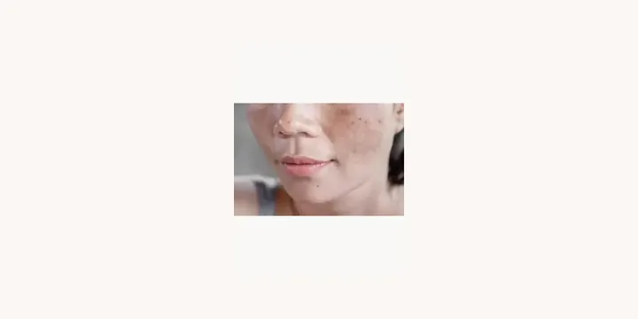 Limpeza Do Fígado Cura Melasma_