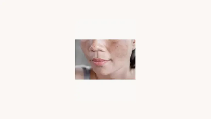 Limpeza Do Fígado Cura Melasma_